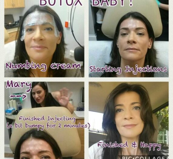 My 1st Botox  experience